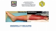 ERISIPELA Y CELULITIS | Leonela Cordova Vena | uDocz