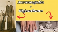 Acromegalia e Gigantismo: Fisiopatologia, Manifestações Clinicas ...