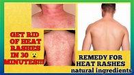 Heat rashes best remedy | prickly heat remedy | how to remove heat ...