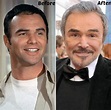 Burt Reynolds Plastic Surgery Before and After Photo | Burt reynolds ...