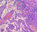 Microfotografía de adenocarcinoma de estómago. adenocarcinoma gástrico ...