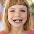 Braces with Missing Teeth | Cartwright Orthodontics