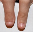 Clubbed thumb - wikidoc