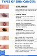 Spelling Out Skin Cancer | Advanced Dermatology Blog