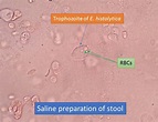 Entamoeba histolytica Trophozoite in saline preparation of stool and ...