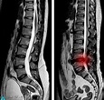 MRI Lumbar spine scan sagittal view Lumbosacral spine has straightening ...