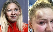 Astrid S i ulykke: - Astrid S avlyser konsert etter surfeulykke