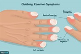 Clubbed Fingers and Nails: Causes and What They Look Like