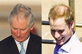 植发有害吗，为什么威廉王子脱发挺厉害的，却没有植发？ - 知乎