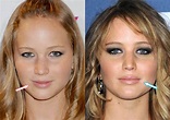 Has Jennifer Lawrence Had Plastic Surgery? (Before & After 2022)