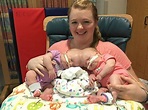 Twins who survived one of the rarest separation surgeries in the world ...