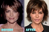 Lisa Rinna Plastic Surgery Before and After - Lovely Surgery ...