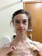 Anorexia survivor who weighed just 5st shares pictures of remarkable ...