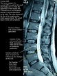 Imaging and the Lumbar Spine: What does it tell us? — AMP Healthcare ...