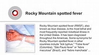 Rocky Mountain Spotted Fever (RMSF) - Bacterial Infections ...
