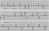 ECG 7.8 Arritmias ventriculares - Cardio Science
