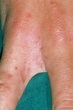 How Do I Get Tested For Scabies?