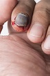 Nail Bed Injury - Zaf Naqui