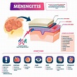 Infant Meningitis and Your Baby's Health | Birth Injury Guide