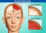 Bacterial Meningitis|Causes|Risk Factors|Symptoms|Diagnosis|Treatment ...