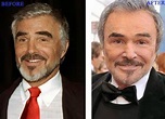 Burt Reynolds Plastic Surgery Facelift Before and After Photos (Star ...