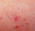 The Best Scabies Treatment | Healthy Living