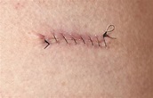Is Wider Suture Spacing Associated With Better Postsurgical Outcomes ...