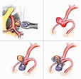 Aneurysm Clipping Treatment