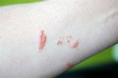Poison Ivy, Poison Oak, and Rashes: What You Need to Know