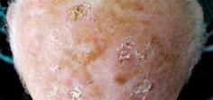 Actinic Keratosis | Dermatology and Skin Health - Dr. Mendese