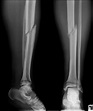orthopedics - How to tell if my leg fracture is healing? - Health Stack ...