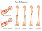 Fracturas y Torceduras: ¿CÓMO SE CLASIFICAN LAS FRACTURAS?