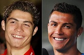 Ronaldo Before And After Plastic Surgery