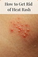 How to Get Rid of Prickly Heat (Heat Rash) | Heat rash, Prickly heat ...