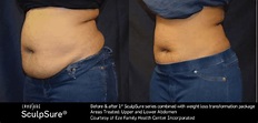 Body Contouring Before & After - Waldorf, MD: Eze Health Center