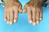 Clubbed fingernails - Stock Image - C010/3261 - Science Photo Library
