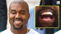 Kanye West Replaces His Teeth With Custom-Made Titanium Dentures