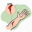 Ilustración Primeros auxilios, brazo lesionado con herida sangrante ...