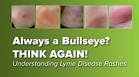 Think the Lyme Disease Rash is Always a Bullseye? THINK AGAIN! : Johns ...