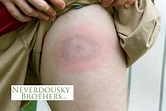 Signs You May Have Lyme Disease - Fairfield Tick Control