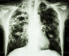 película radiografía de tórax muestra cavidad en el pulmón derecho ...