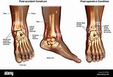 Las fracturas de tobillo Trimalleolar del tobillo izquierdo con ...
