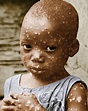 Posterazzi: Child With Smallpox Poster Print by Science Source (18 x 24 ...