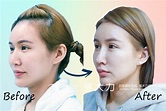 三段式韓式隆鼻｜日記分享-東京風采整形外科診所