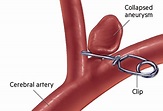 Surgical Treatment: Clipping - Brain Aneurysm Foundation