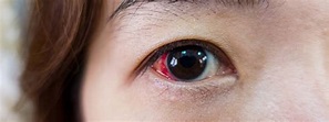 Common Eye Injuries - Dr. Barry Leonard and Associates
