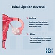 Tubal Ligation Reversal - Women's Reproductive Health Center