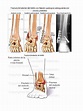 Fractura de Tobillo Gle | Tobillo | Osteoartritis