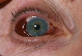 Eye injury - Stock Image - M330/1128 - Science Photo Library