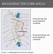 Understanding Cobb Angles and what it means for Scoliosis